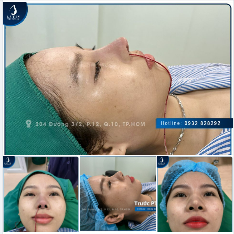 Mũi tái cấu trúc cho chị khách bị bao xơ sẽ như thế nào