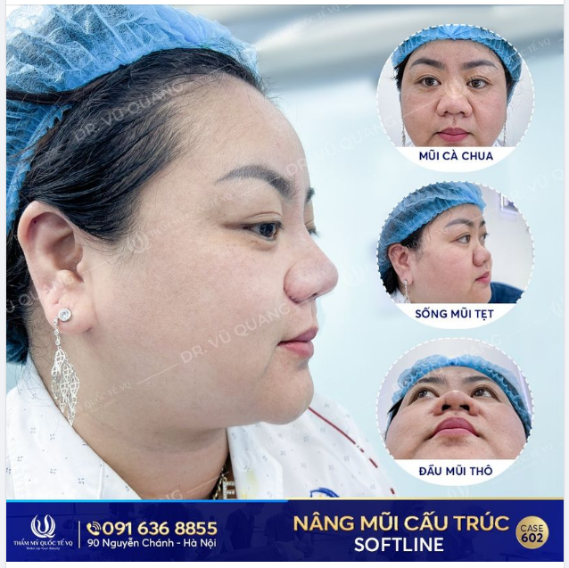 Mũi Tẹt, Mũi cà chua Bất Lợi Đủ Đường