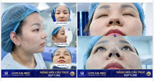 Mũi tẹt ngắn hếch thay đổi thế nào