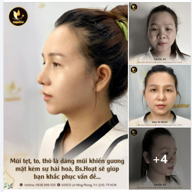 Mũi tẹt, to thô là dáng mũi khiến gương mặt kém đi sự hài hòa, Bs.Hoạt sẽ giúp bạn khắc phục vấn đề này...