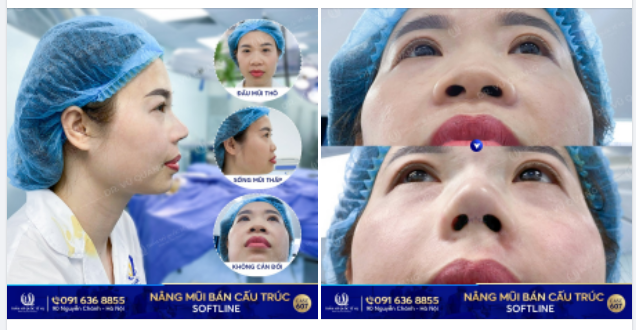 MŨI THẤP, BÈ, THÔ, KHÔNG CÂN ĐỐI THAY ĐỔI thế nào sau Nâng mũi bán cấu trúc Softline