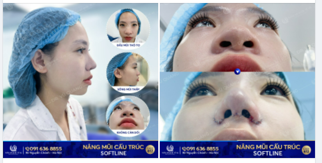 MŨI THÔ TO, THẤP - CẢN XINH ĐẸP - CHẶN TÀI LỘC