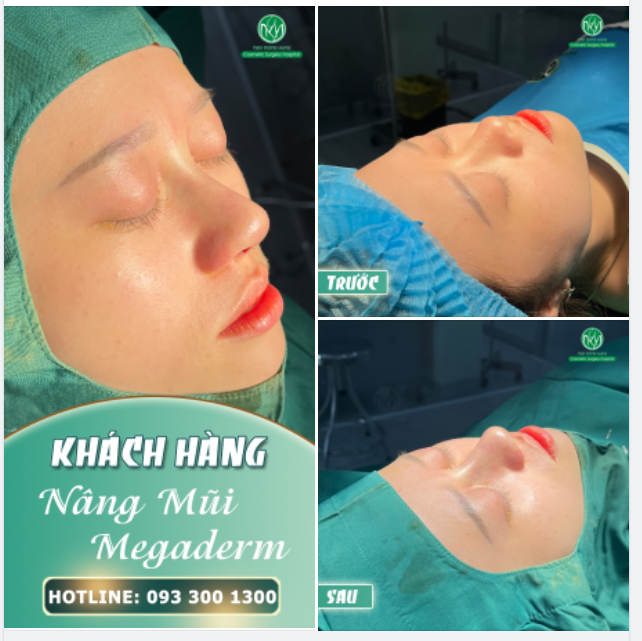 MUỐN MŨI ĐẸP KHÔNG KHÓ
