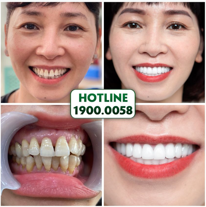 MUỐN RĂNG KHỎE, MUỐN RĂNG ĐẸP THÌ ĐẾN NHA KHOA GIA ĐÌNH