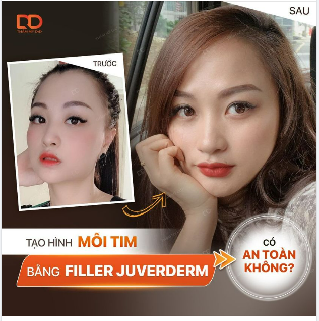 Muốn tạo hình môi tim NHƯNG Không thích phẫu thuật. Sợ tiêm trúng Filler trôi nổi.