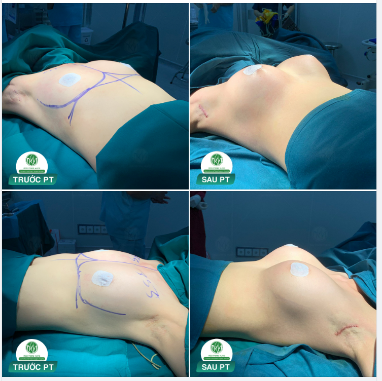 NÂNG CẤP VÓC DÁNG - NGỰC ĐẸP HOÀN HẢO
