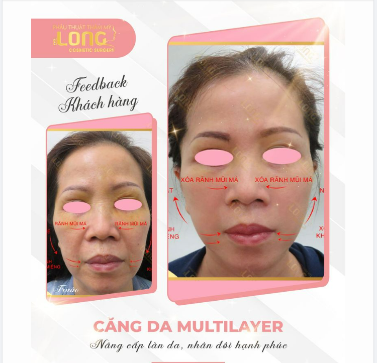 NÂNG CƠ CĂNG DA ĐỈNH CAO CHỈ VỚI 1 LẦN THỰC HIỆN