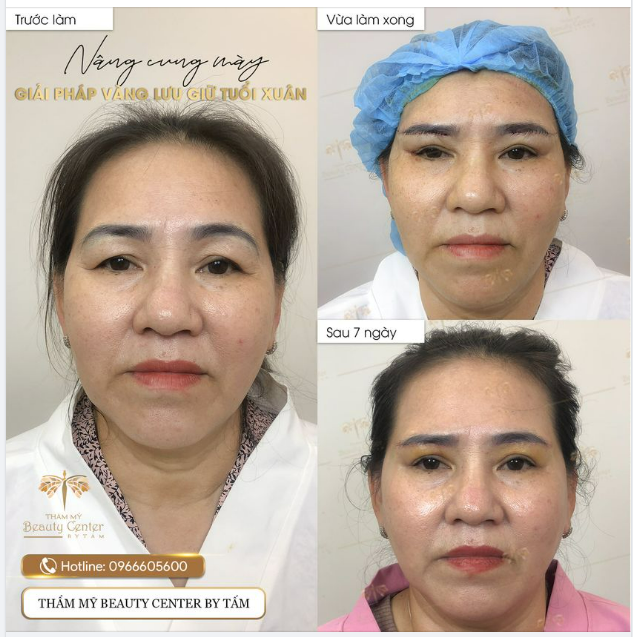 NÂNG CUNG CHÂN MÀY - HỒI XUÂN ĐÔI MẮT