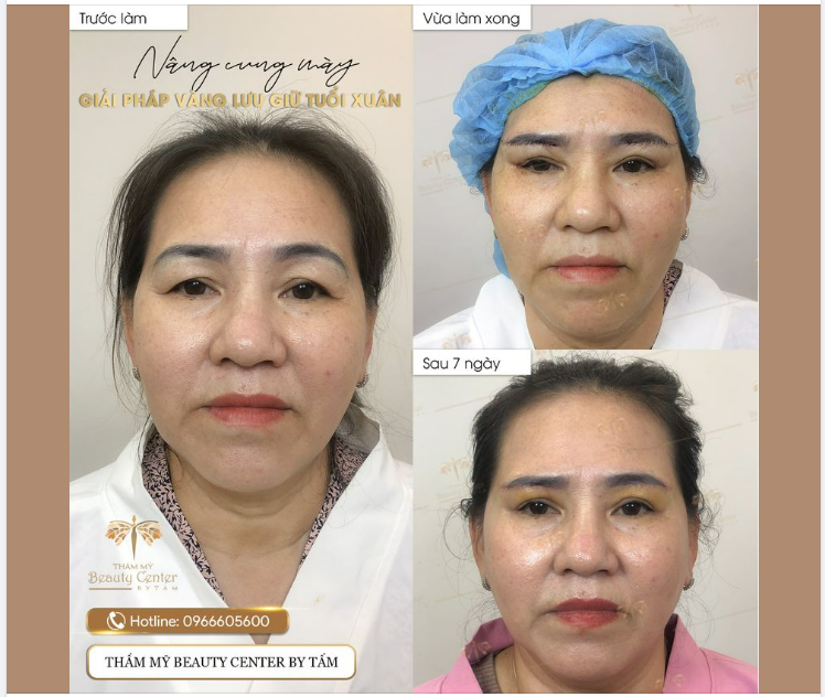 NÂNG CUNG CHÂN MÀY-HỒI XUÂN ĐÔI MẮT
