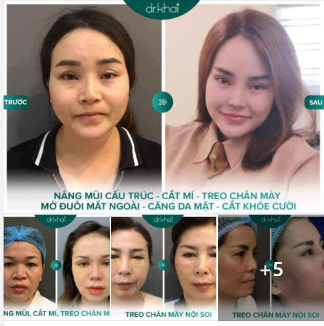 NÂNG KHUNG CHÂN MÀY NỘI SOI - HIỆU QUẢ CHỈ SAU 1 LẦN THỰC HIỆN