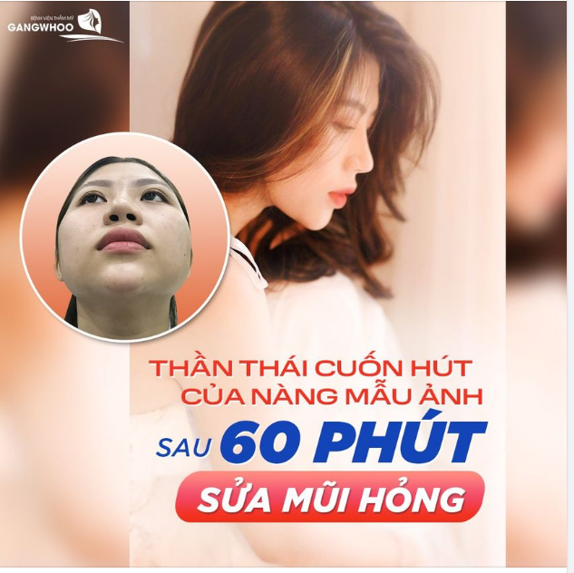 NÀNG MẪU ẢNH PHÁT TRIỂN SỰ NGHIỆP SAU 1 NĂM SỬA MŨI HỎNG