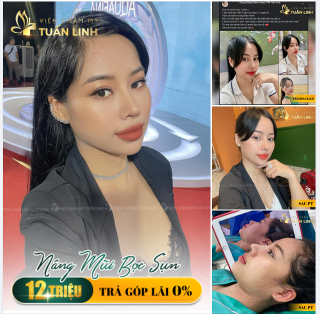 Nâng mũi bọc sụn tai - Giá chỉ 12 triệu 