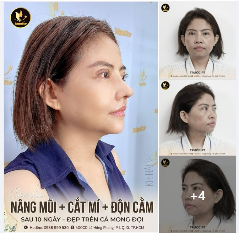 NÂNG MŨI + CẮT MÍ + ĐỘN CẰM - ĐẸP TRÊN CẢ MONG ĐỢI CỦA KHÁCH HÀNG