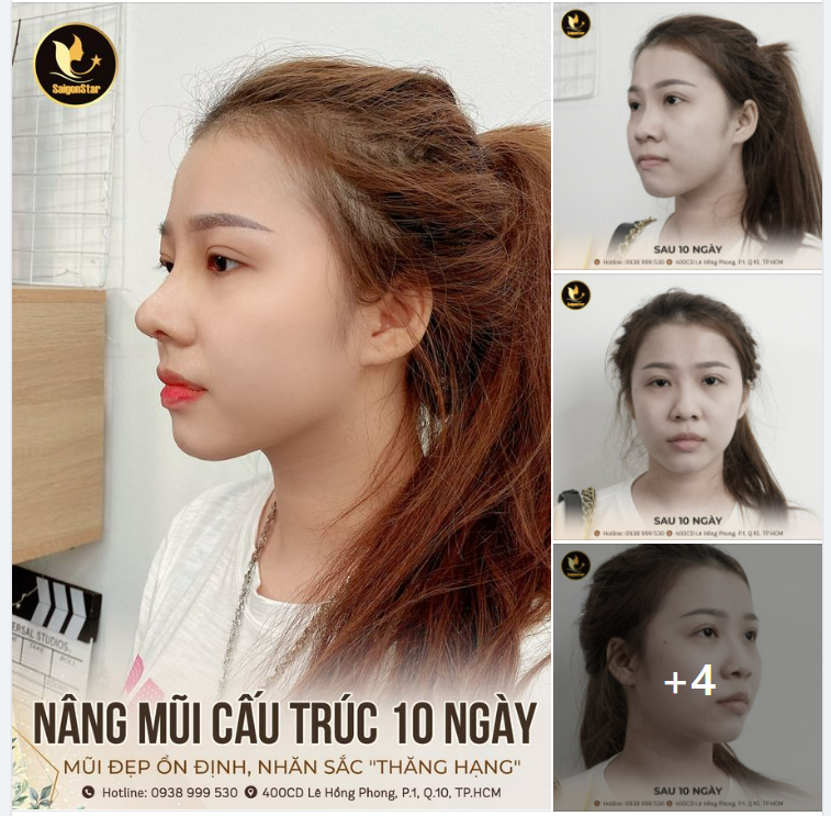 NÂNG MŨI CẤU TRÚC 10 NGÀY - MŨI ĐẸP ỔN ĐỊNH NHAN SẮC THĂNG HẠNG