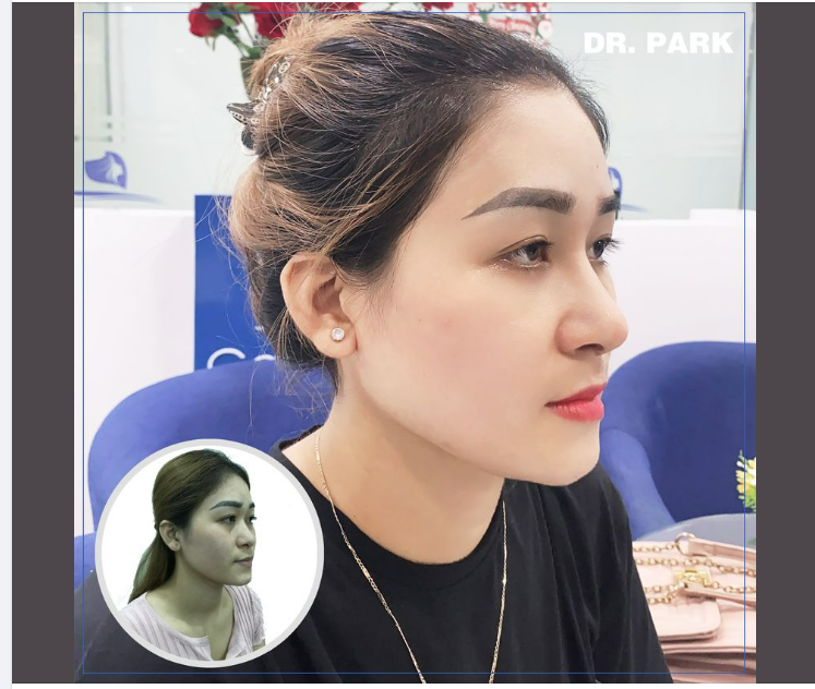 NÂNG MŨI CẤU TRÚC - MỞ RA TRANG MỚI CUỘC ĐỜI