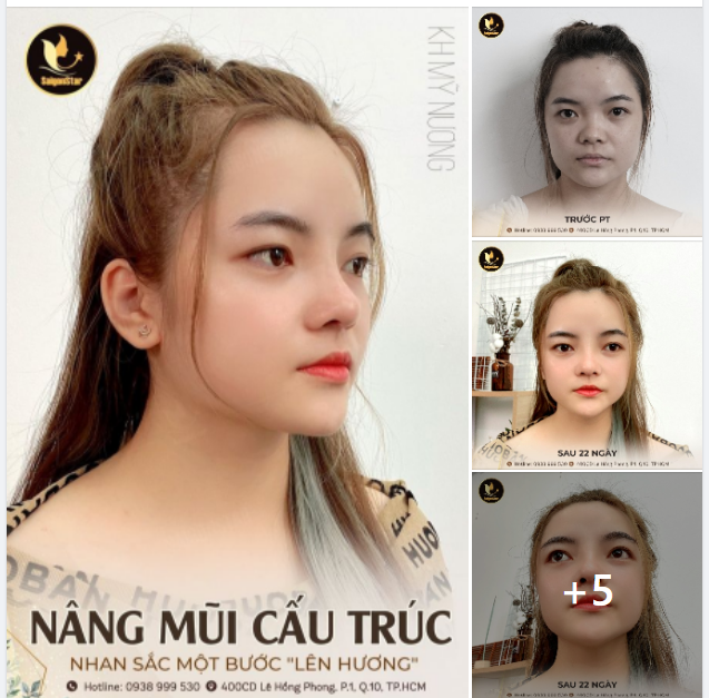 NÂNG MŨI CẤU TRÚC NHAN SẮC MỘT BƯỚC LÊN HƯƠNG