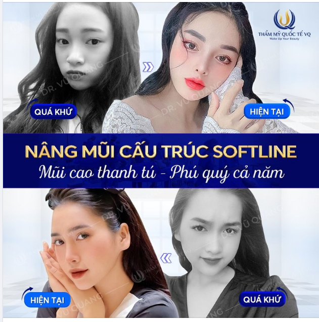 Nâng mũi cấu trúc Softline - Mũi cao thanh tú - Phú quý cả năm chỉ với 35tr - Nhận thêm 5tr.