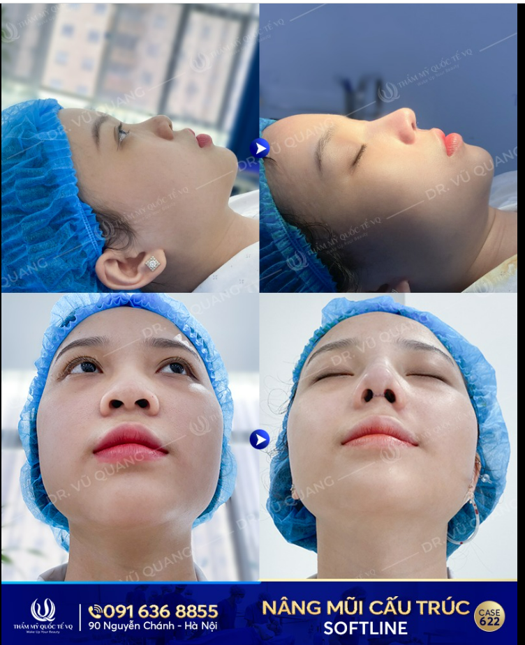 Nâng mũi cấu trúc Softline - Mũi cao xinh - Rinh may mắn chỉ với 35tr - Nhận thêm 5tr tiền mặt.