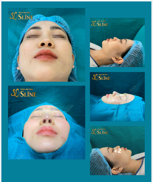 Nâng mũi cấu trúc Softxil là gì