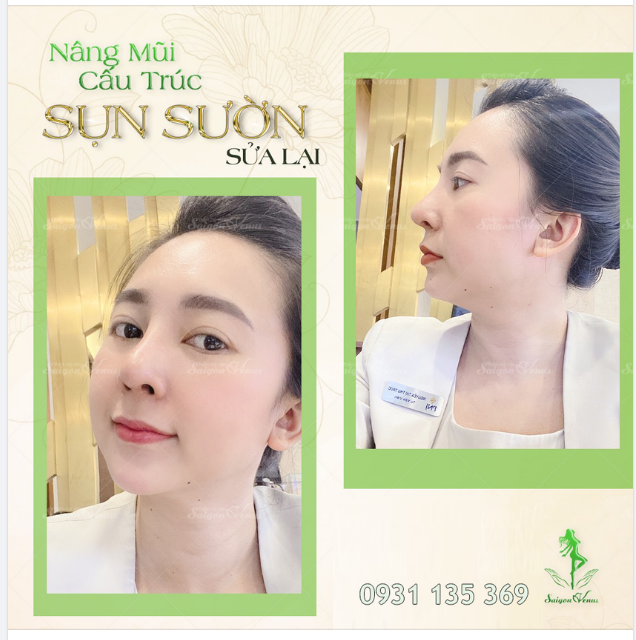 NÂNG MŨI CẤU TRÚC SỤN SƯỜN