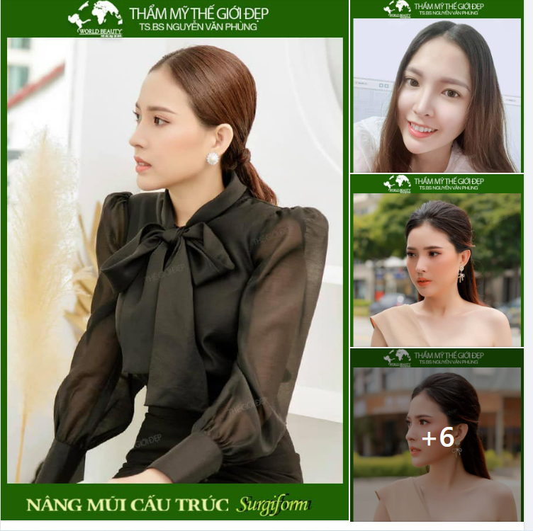 Nâng mũi cấu trúc Surgiform - Giải pháp giúp hoàn thiện dung mạo xinh đẹp cho quý cô thành đạt