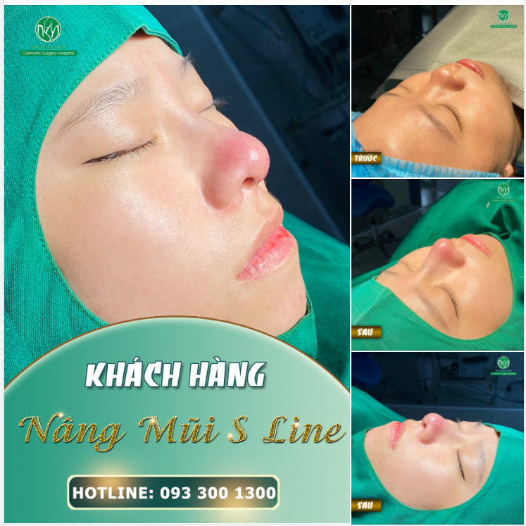 NÂNG MŨI ĐỂ XINH ĐẸP VÀ TỰ TIN HƠN