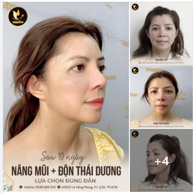 NÂNG MŨI + ĐỘN THÁI DƯƠNG SAU 10 NGÀY - MỘT LỰA CHỌN ĐÚNG ĐẮN