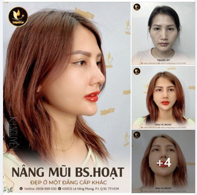 NÂNG MŨI DR.HOẠT, ĐẸP Ở MỘT ĐẲNG CẤP KHÁC