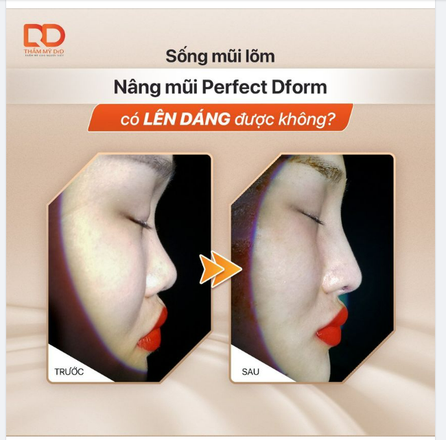 NÂNG MŨI GÃY CÓ LÊN DÁNG ĐƯỢC KHÔNG