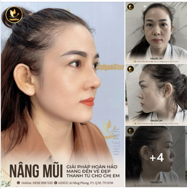NÂNG MŨI - GIẢI PHÁP HOÀN HẢO MANG ĐẾN VẺ ĐẸP THANH TÚ CHO CHỊ EM