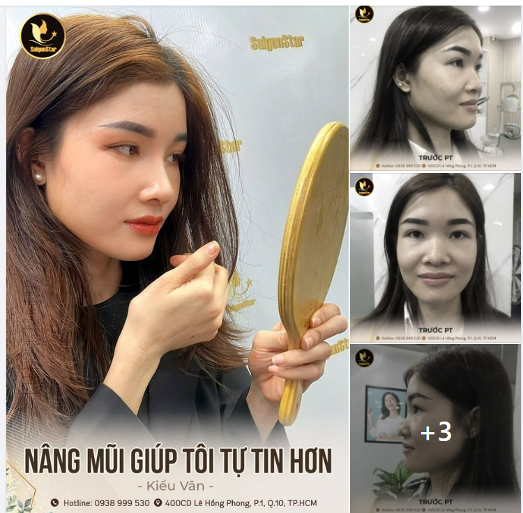 NÂNG MŨI GIÚP TÔI TỰ TIN HƠN