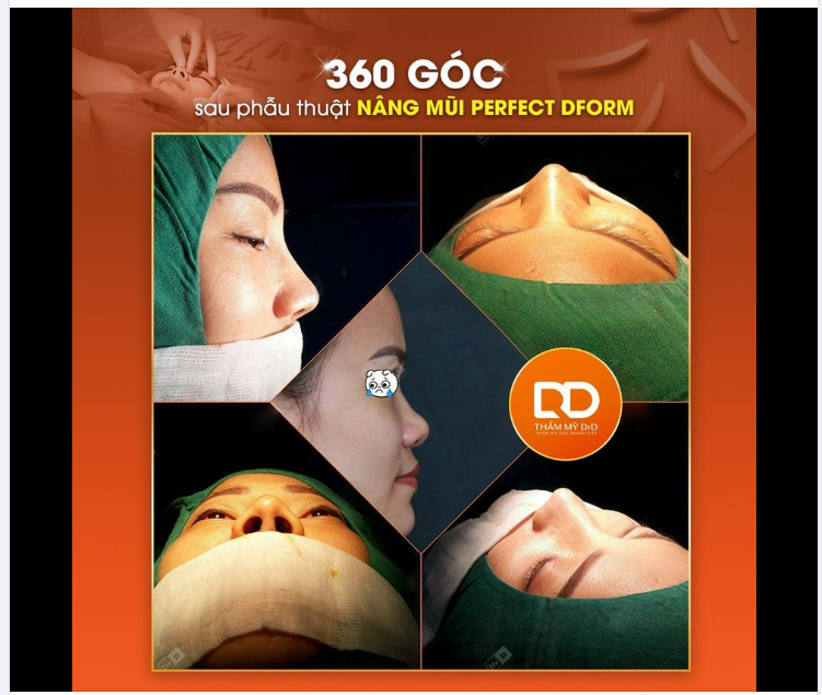NÂNG MŨI PERFECT DFORM, CHINH PHỤC MỌI GÓC NHÌN