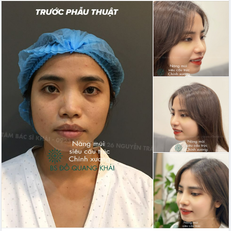 NÂNG MŨI SIÊU CẤU TRÚC SỐNG MŨI TỰ NHIÊN CA MŨI CHỈNH XƯƠNG SAU 15 NGÀY THỰC HIỆN CỦA CÔ NÀNG HOTGIRL
