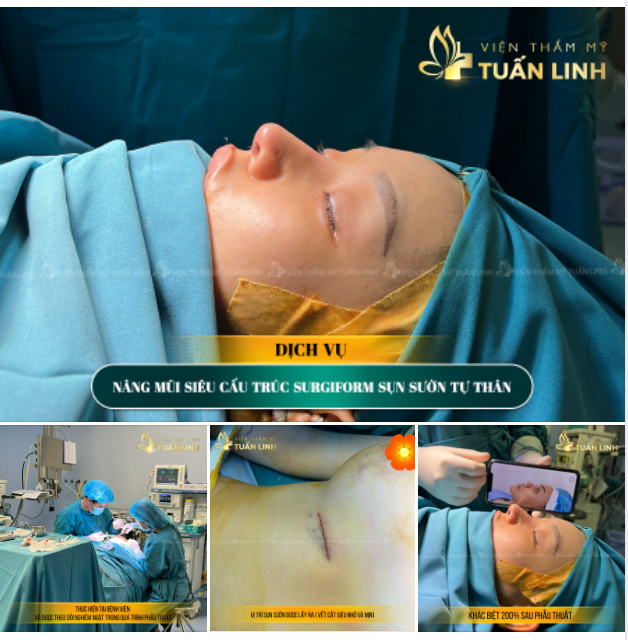 NÂNG MŨI SIÊU CẤU TRÚC SURGIFORM KẾT HỢP SỤN SƯỜN TỰ THÂN - HOÀN THIỆN TOÀN DIỆN MỌI KHUYẾT ĐIỂM