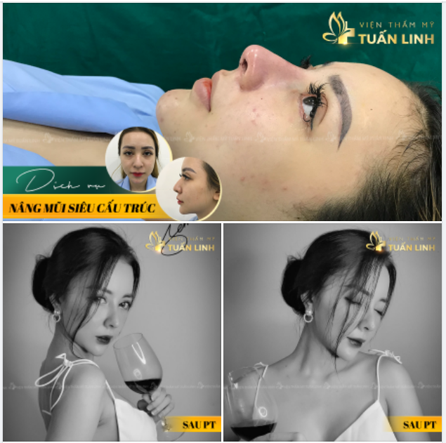 NÂNG MŨI SIÊU CẤU TRÚC
