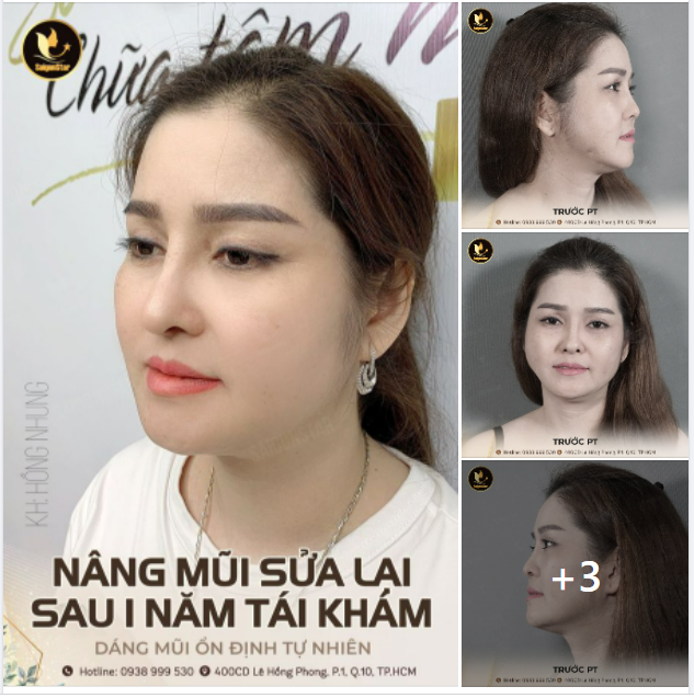 NÂNG MŨI SỬA LẠI SAU 1 NĂM TÁI KHÁM – DÁNG MŨI ỔN ĐỊNH TỰ NHIÊN