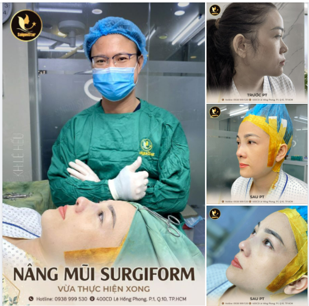 NÂNG MŨI SURGIFORM VỪA THỰC HIỆN XONG