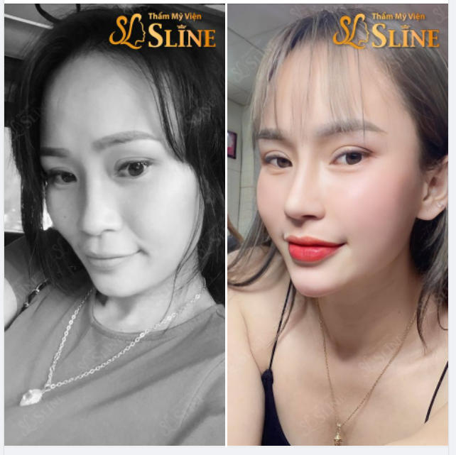 NÂNG MŨI.... sẽ giúp khuôn mặt bạn trở nên cân đối và sang chảnh hơn, hình ảnh khách hàng sau nâng mũi tại Thẩm Mỹ Viện Sline.