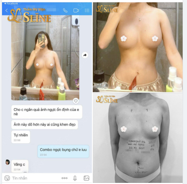 Nâng ngực Hút mỡ bụng với Ekip Sline
