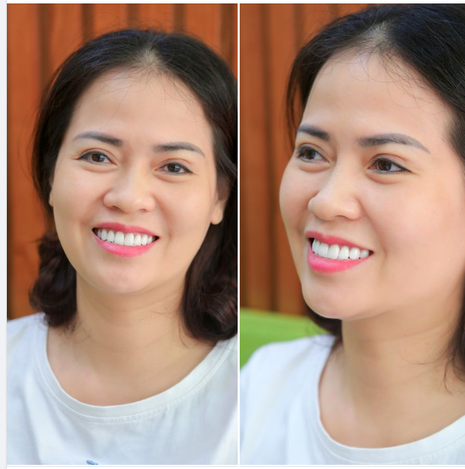 NGẨN NGƠ TRƯỚC VẺ ĐẸP "SẮC NƯỚC HƯƠNG TRỜI" SAU KHI THẨM MỸ RĂNG SỨ
