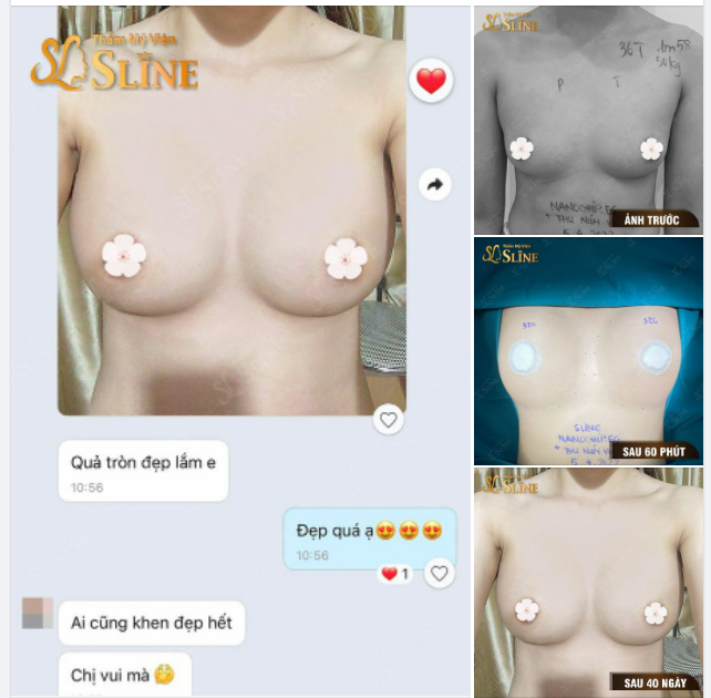 Ngực 1 tháng tuổi sẽ như thế này đây
