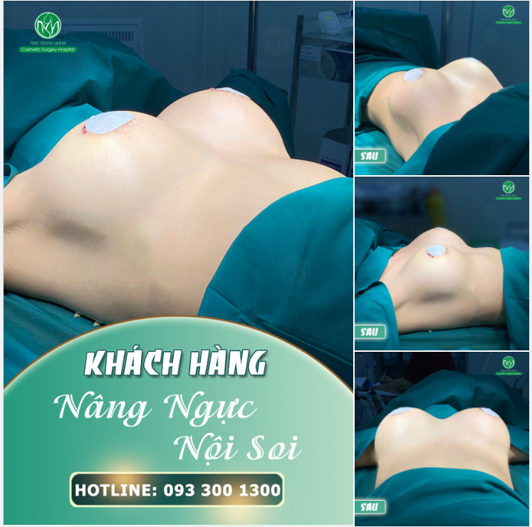 NGỰC ĐẸP BẤT NGỜ NHỜ NÂNG NGỰC NỘI SOI ĐẶT TÚI