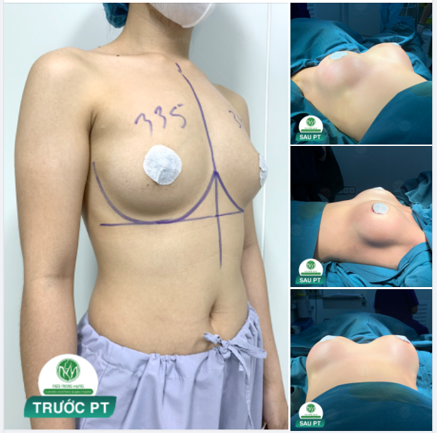 NGỰC ĐẸP CHO HÈ THÊM RẠNG RỠ