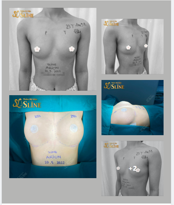 Ngực đẹp cùng Sline Khách hàng sử dụng dòng túi Arion đến từ nước Pháp, size 285Cc.