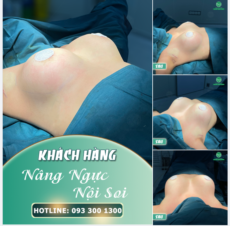 NGỰC ĐẸP HOÀN HẢO - TRỌN GÓI CHỈ 52TRIỆU