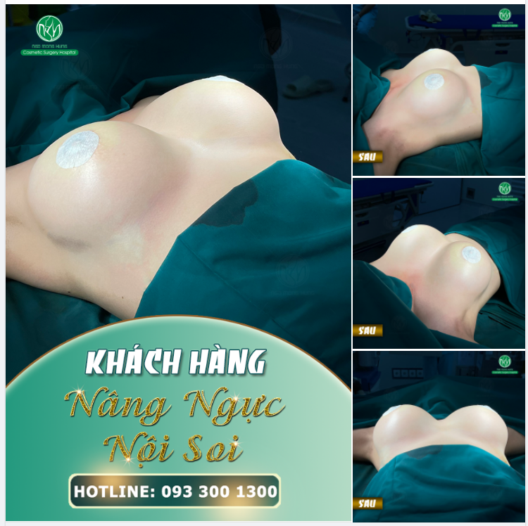 NGỰC ĐẸP LÀ NHỜ NÂNG NGỰC ĐẶT TÚI TẠI BVTM NGÔ MỘNG HÙNG
