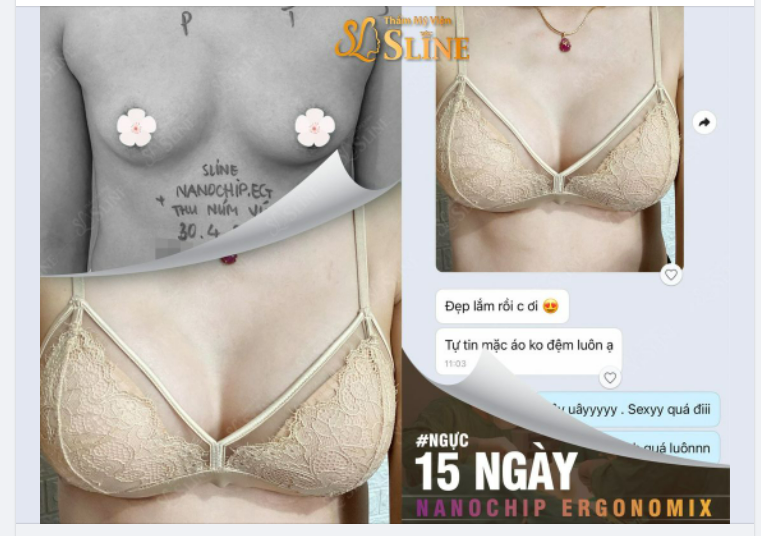 Ngực đẹp sau 15 ngày.