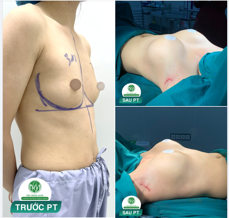 NGỰC NỘI SOI ĐƯỜNG NÁCH CHO KH TỪ ĐỒNG NAI