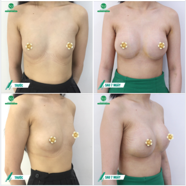 NGỰC NỘI SOI ĐƯỜNG NÁCH SAU 7 NGÀY THỰC HIỆN