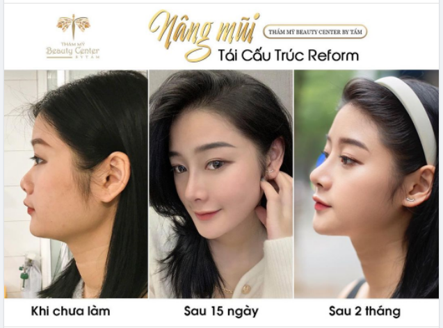 Người đẹp vì lụa Mũi đẹp là vì nâng mũi tái cấu trúc Reform